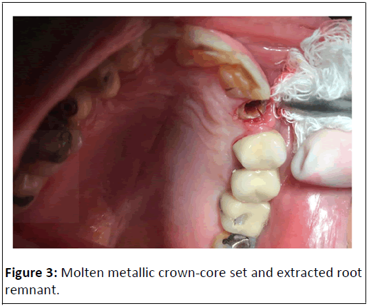 Orthodontics-metallic
