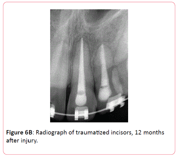 orthodontics-endodontics-12-months-after