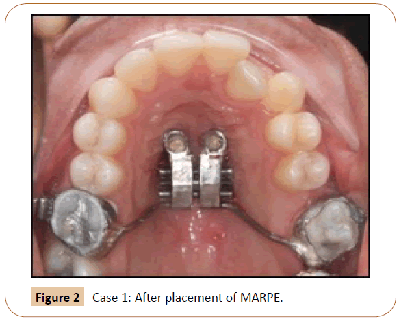 orthodontics-endodontics-After-placement