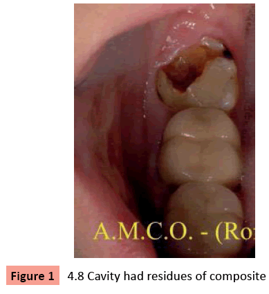 orthodontics-endodontics-Cavity-residues-composite