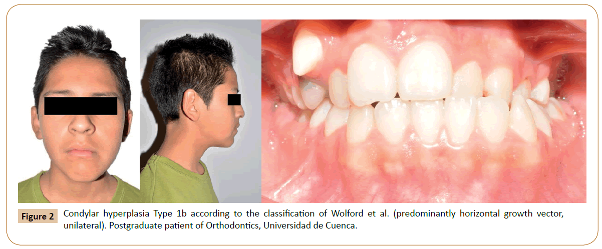 orthodontics-endodontics-Condylar-hyperplasia