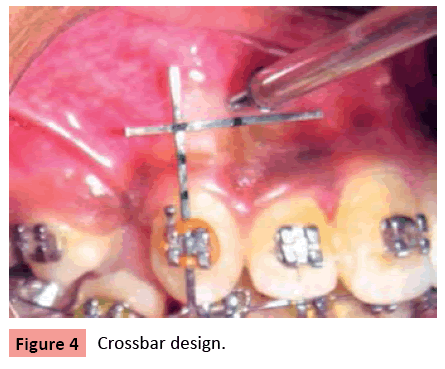 orthodontics-endodontics-Crossbar-design