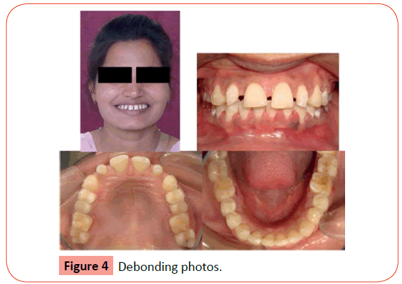 orthodontics-endodontics-Debonding-photos