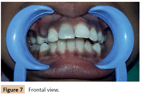 orthodontics-endodontics-Frontal-view