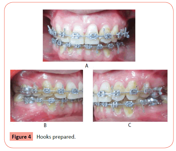 orthodontics-endodontics-Hooks-prepared
