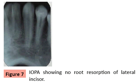 orthodontics-endodontics-IOPA-showing-no-root