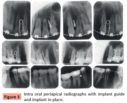 orthodontics-endodontics-Intra-oral-periapical-radiographs