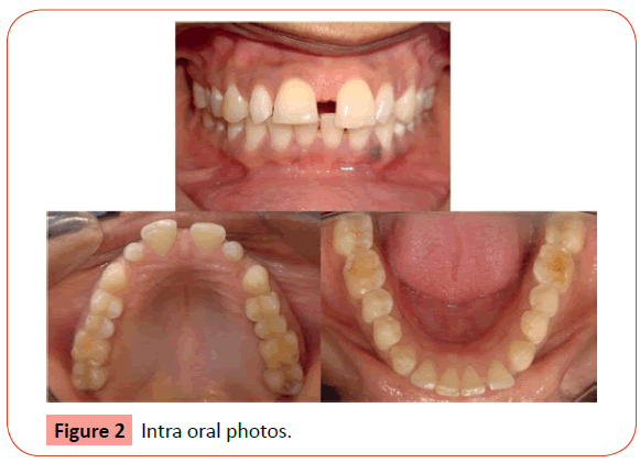 orthodontics-endodontics-Intra-oral-photos