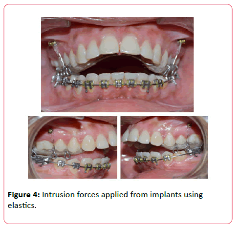 orthodontics-endodontics-Intrusion-forces-applied