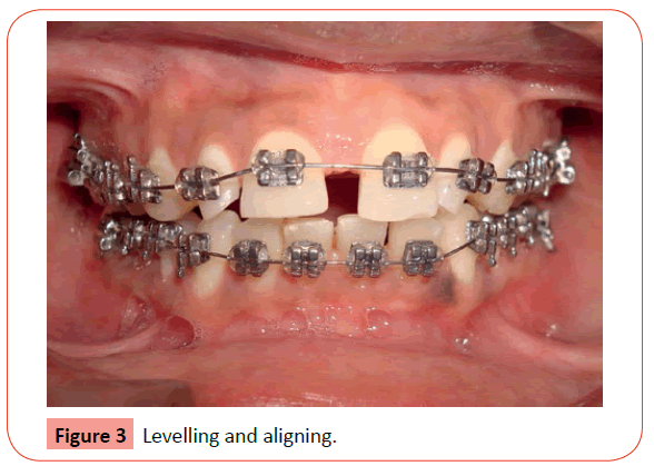orthodontics-endodontics-Levelling-aligning