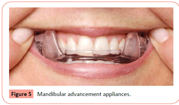 orthodontics-endodontics-Mandibular-advancement