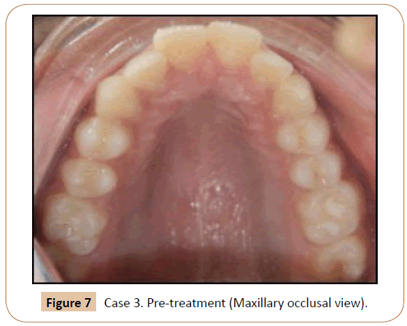 orthodontics-endodontics-Maxillary