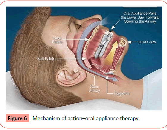orthodontics-endodontics-Mechanism-action
