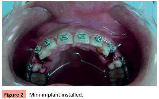 orthodontics-endodontics-Mini-implant-installed