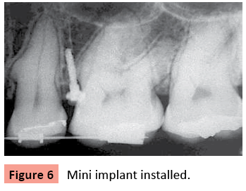 orthodontics-endodontics-Mini-implant-installed