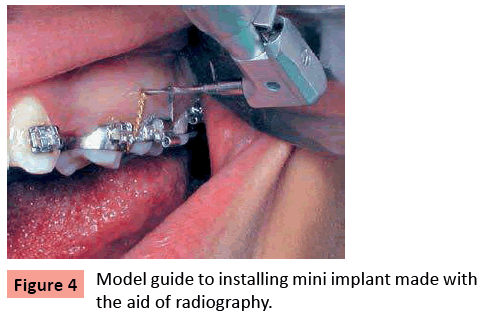 orthodontics-endodontics-Model-guide-installing