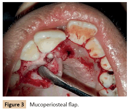orthodontics-endodontics-Mucoperiosteal-flap