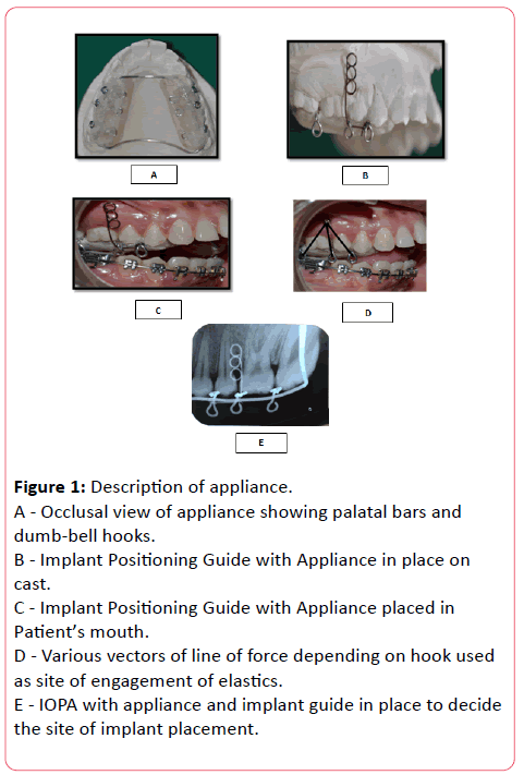 orthodontics-endodontics-Occlusal-view-appliance