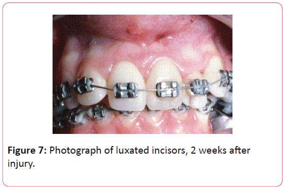orthodontics-endodontics-Photograph-luxated-incisors