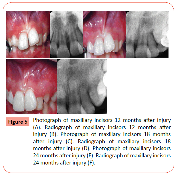 orthodontics-endodontics-Photograph-maxillary