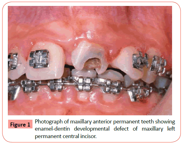 orthodontics-endodontics-Photograph-maxillary-anterior