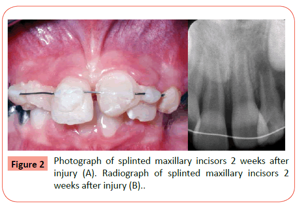 orthodontics-endodontics-Photograph-splinted-maxillary