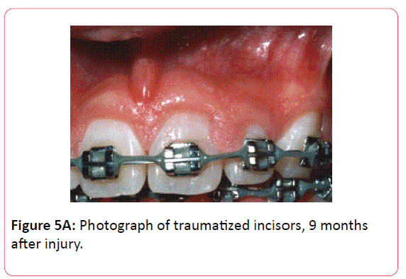 orthodontics-endodontics-Photograph-traumatized-incisors