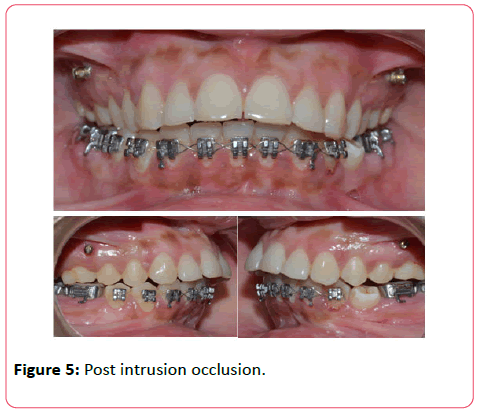 orthodontics-endodontics-Post-intrusion-occlusion