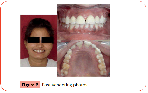 orthodontics-endodontics-Post-veneering-photos