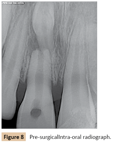 orthodontics-endodontics-Pre-surgicalIntra-oral