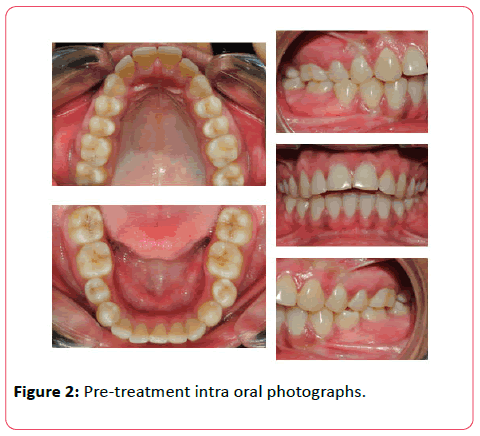 orthodontics-endodontics-Pre-treatment-intra