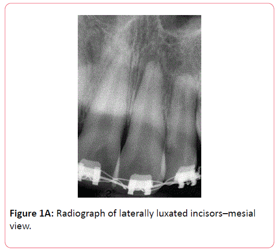 orthodontics-endodontics-Radiograph-laterally