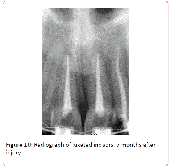 orthodontics-endodontics-Radiograph-luxated-incisors
