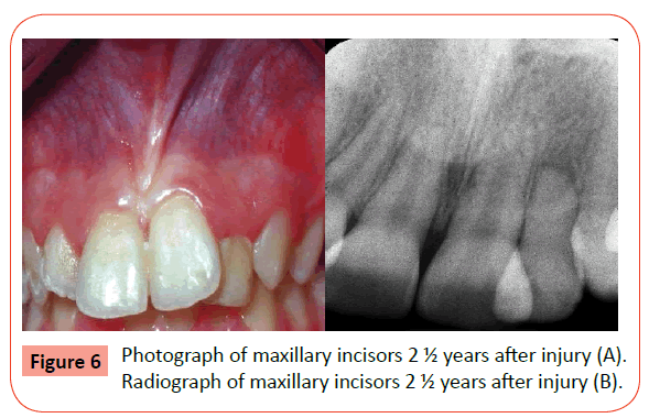 orthodontics-endodontics-Radiograph-maxillary