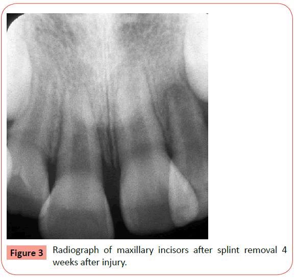 orthodontics-endodontics-Radiograph-maxillary-incisors