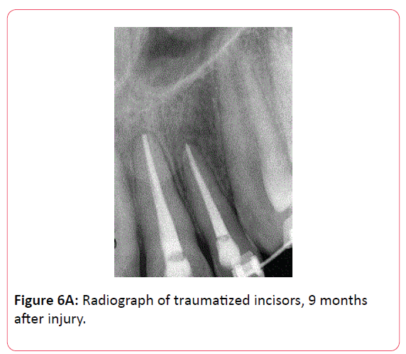 orthodontics-endodontics-Radiograph-traumatized-incisors