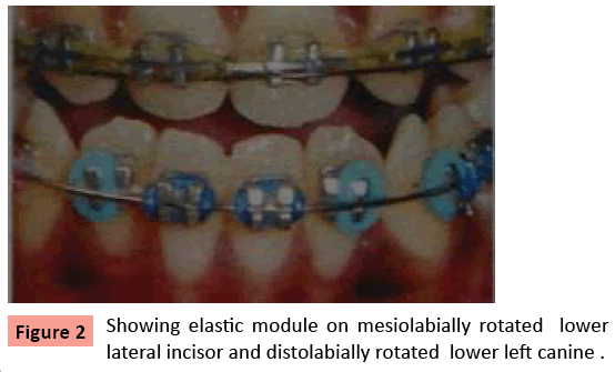orthodontics-endodontics-Showing-elastic-module