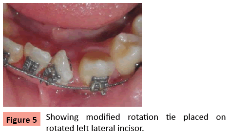 orthodontics-endodontics-Showing-modified-rotation-tie