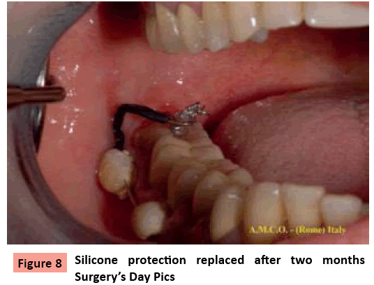 orthodontics-endodontics-Silicone-protection-replaced