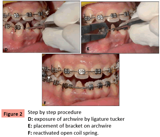 orthodontics-endodontics-Step-step-procedure