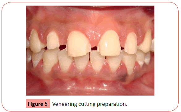 orthodontics-endodontics-Veneering-cutting-preparation