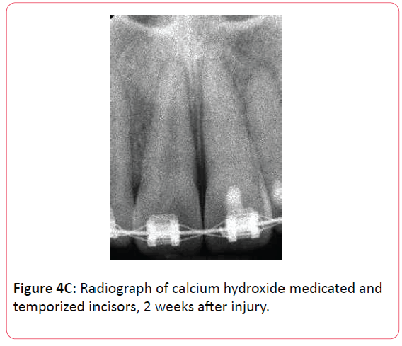 orthodontics-endodontics-calcium-hydroxide-medicated