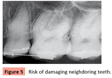 orthodontics-endodontics-damaging-neighdoring-teeth