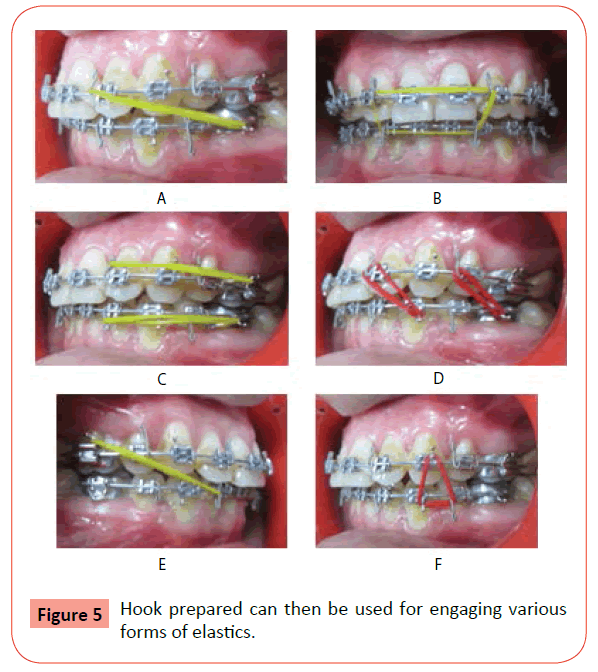 Customized Ligature Hook: A Noble Approach for Engaging Elastic in Fixed  Orthodontics