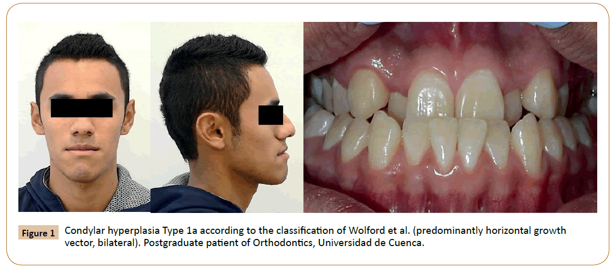 orthodontics-endodontics-hyperplasia