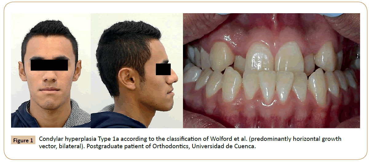 Alternatives for Treatment of Facial Asymmetry by Condylar