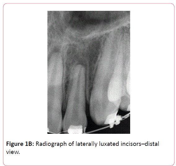 orthodontics-endodontics-incisors–distal