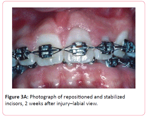 orthodontics-endodontics-injury-labial