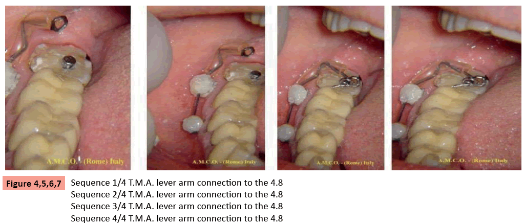 orthodontics-endodontics-lever-arm-connection