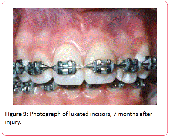 orthodontics-endodontics-luxated-incisors-7-months